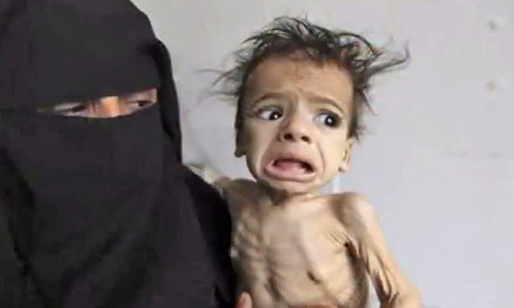 0420 Hunger Yemeni chn